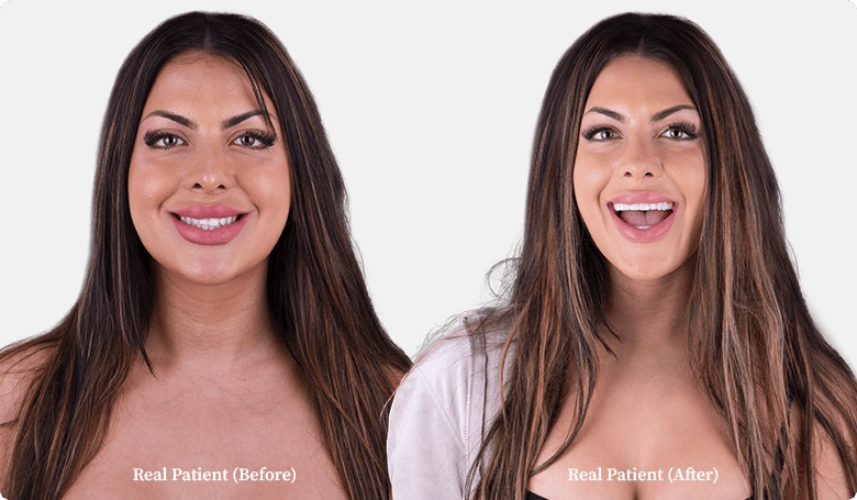 patient of Dental Clinic Mexico all on 4 implants